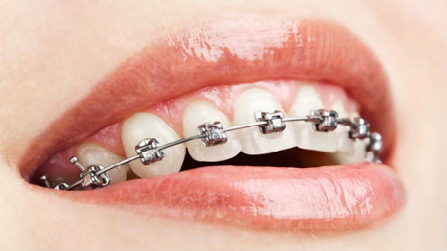 ¿Por qué sueñas con frenos en los dientes?